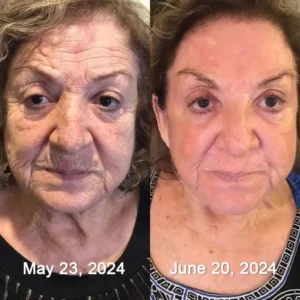 Botox & Retinol Shot - Eraser for deep wrinkles, sagging jawls & puffy eyes