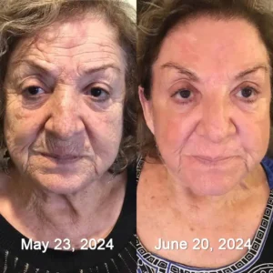 👩‍⚕️
        🏆
      

      
        Made and shipped from the Canada
        Made & shipped from Canada
      
    

          
          
          
          
          
          
          
          
          
          
            
            
            
            
          
        
      
    

    
      💫
      Celestvéra®
      Botox & Vita-A Retinol Shot Wrinkle-Lift Tightening Cream
    

    
      🔥Last Day Promotion
      70% OFF